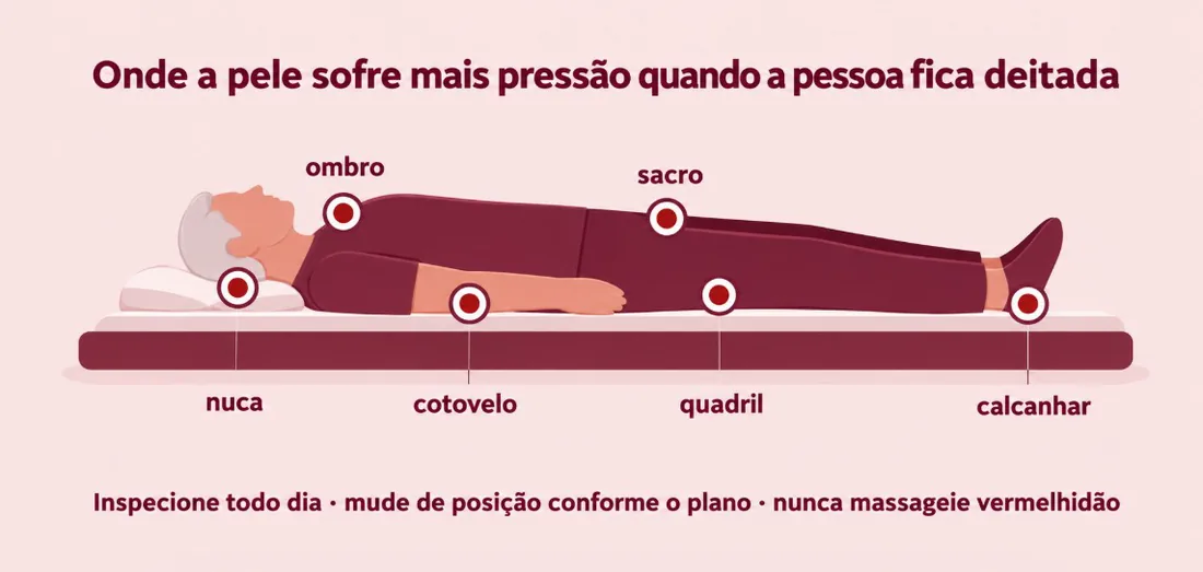 Onde a pele sofre mais pressão quando a pessoa fica deitada: nuca, ombro, cotovelo, sacro, quadril e calcanhar